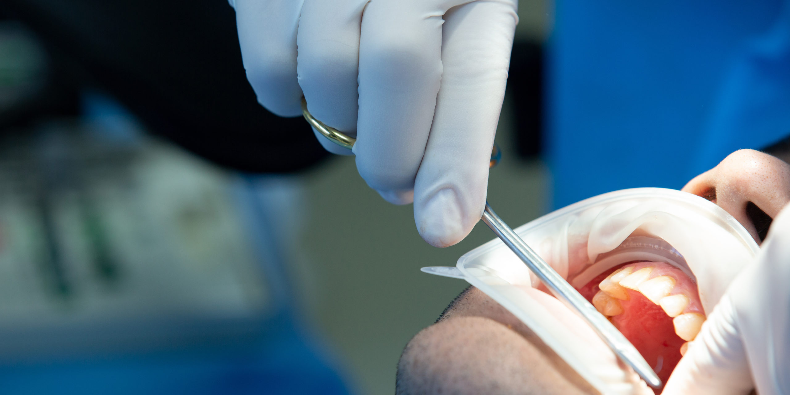 Person getting tooth extracted at dentist