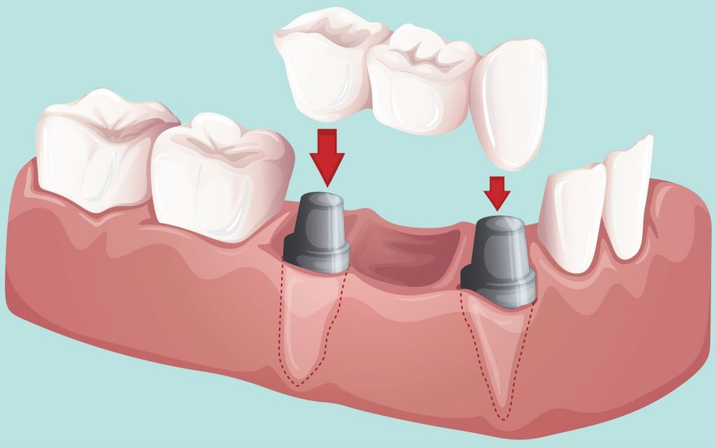 image illustration of two metal bolts inside mouth where teeth screw into